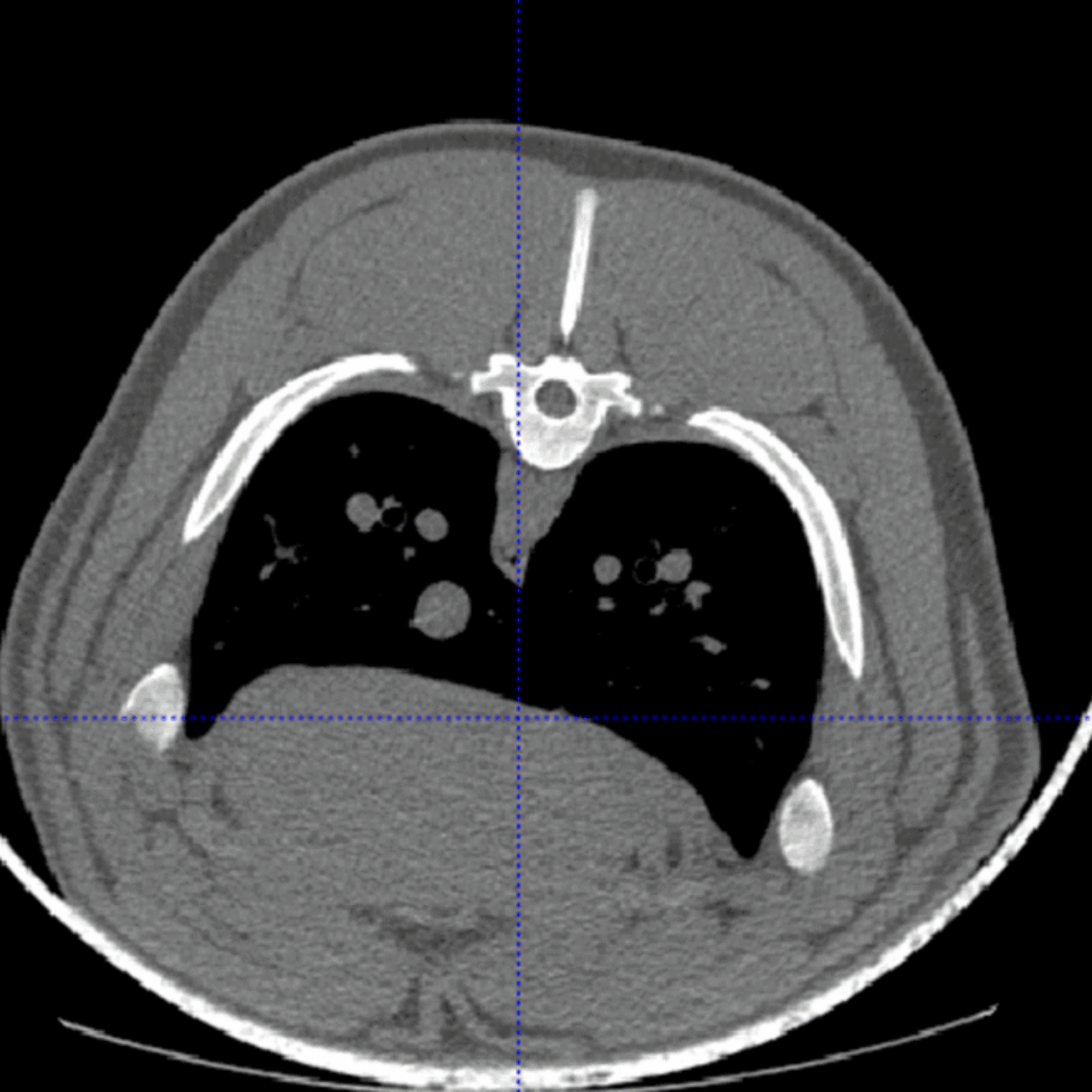 Bridging Pig Breeding and Human Health with CT Data